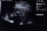 Ultrahangfotó - eltántoríthat az abortusztól?